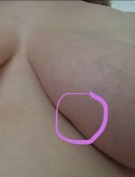 The dimpling on her skin was the only symptom warner experienced, and she only knew that it could be a cause for worry because of a breast cancer awareness photograph she'd seen previously. Julie Mccarthy On Twitter Imagine Being 30 And Having Your Birthday Soon Imagine Noticing A Change In Your Breast A Tiny Dimple But Still You Know You Need To Get It Checked