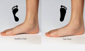 Image result for Clubfoot