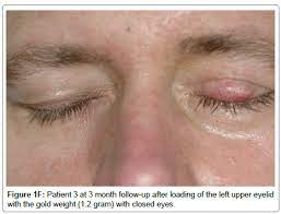 Massry makes an incision into the upper eyelid crease. Complications Associated With The Surgical Techniques Of Upper Eyelid Loading A Clinicopathologic Study Of 7 Explanted Gold Weight Lid Loads Scitechnol