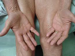 Andrews' diseases of the skin. Adenocarcinoma Of The Lung Associated With Pityriasis Rubra Pilaris