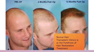 Hair transplant los angeles, specialist marc dauer md, is a hair transplant surgeon and eyebrow transplant pioneer offering hair restoration and eyebrow restoration. Best Hair Restoration Hair Transplant Los Angeles Youtube
