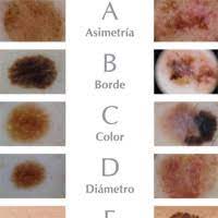 They describe the physical condition and/or progression of any skin abnormality that would suggest the development of a malignancy. Abcde Melanoma Hc Marbella International Hospital