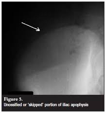 Image result for Risser Sign