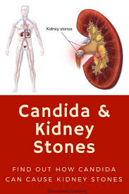If You Are Struggling With Kidney Stones Learn How Candida Overgrowth Can Increase Your Chances Of Gettin Kidney Stone Diet Kidney Stones Kidney Stones Remedy