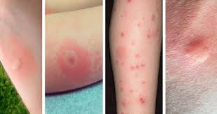Bites That Look Like Bed Bug Bites But Aren T Pin On Important