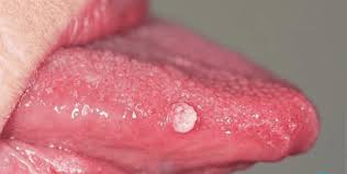 Image result for papillomavirus tongue)