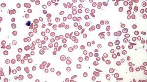 Sickle cell anemia, also called sickle cell disease (ss disease), is an inherited condition caused by having abnormal hemoglobin, the protein that carries oxygen in the blood. Sickle Cell Anemia Traced Back To One Baby Born 7300 Years Ago Science Aaas