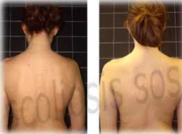 There may be pain, discomfort and an overall difficulty in using one's body when scoliosis is present, but again, maybe not. Egyptian Scoliosis Patient Scoliosis Sos Testimonial
