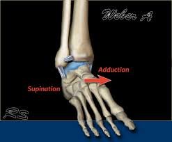 Maisonneuve fracture is a severe ankle injury which arises due to a spiral fracture of the proximal third of the fibula along with a tear of the distal tibiofibular syndesmosis and interosseous membrane. The Radiology Assistant Weber And Lauge Hansen Classification