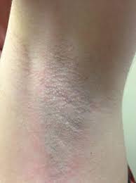 Laser hair removal is no exception; Laser Hair Removal Springerlink