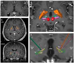 Image result for Thalamic Stimulation