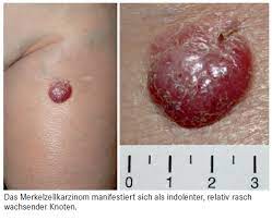 Das merkelzellkarzinom oder kutane neuroendokrine karzinom der haut ist ein sehr seltener bösartiger hauttumor. Merkelzellkarzinom Und Angiosarkom Medonline
