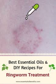 Best Essential Oils And Essential Oil Recipes For Ringworm Essential Oil Benefits Best Essential Oils Home Remedies For Ringworm Essential Oil Recipes