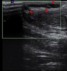 We did not find results for: References In Penile Mondor Disease And Its Effect On Erectile Function Results Of 30 Patients Urology