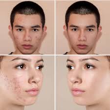 Image result for acne face