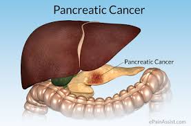 Consult a doctor for medical advice. Pancreatic Cancer Stages Types Causes Risk Factors Signs Symptoms Treatment
