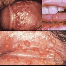 Image result for genital herpes