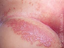 Image result for diaper dermatitis