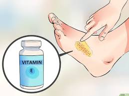 إزالة الغرز الجراحية في المنزل Wikihow