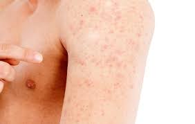 An itchy, red and bumpy rash on the skin is a sign of skin irritation. Heat Rash Treatment Men S Health
