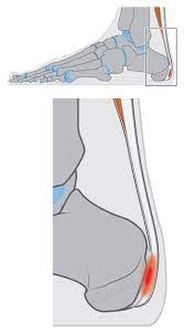 Pijnlijke Achillespees Blog Hielpijncentrum