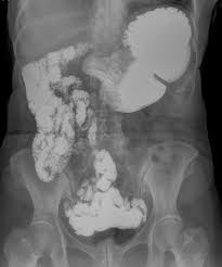 Image result for Intestinal Malrotation