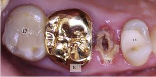 Wann fallen welche milchzähne aus? Revision An Molaren Endodontie Dr Eggert