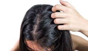 Oily Scalp: Why You Have It And How To Prevent It | Nizoral