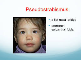 The general appearance is inspected for plethora (maternofetal transfusion), macrosomia (maternal diabetes), and lethargy or extreme irritability (sepsis or infection) and for any dysmorphic features such as macroglossia (hypothyroidism) and flat nasal bridge or bilateral epicanthal folds (down syndrome). Strabismus Amblyopia Leukocoria Ppt Video Online Download