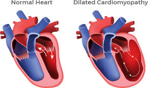 Image result for Cardiomyopathy