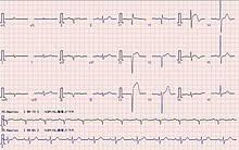 Uncertain if conversion was spontaneous, or done electrically in the cath lab rbbb and lafb persist (not a good sign). Myocardial Infarction Wikipedia