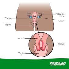 More than 4,200 women in the u.s. Macmillan Cancer Support This Week Is Cervicalcancerpreventionweek Very Early Stage Cervical Cancer May Not Cause Any Symptoms It Is Usually Found And Treated Because Of Cervical Screening Tests But It S Good To