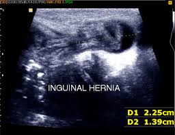 Inner surfaces of the 7th to 12th ribs, thoracolumbar fascia, inner lip of the iliac crest, anterior superior iliac spine, inguinal ligament. Inguinoscrotal And Inguinolabial Swelling In Infancy Role Of Ultrasound Sciencedirect