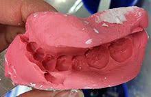 Check spelling or type a new query. Dental Impression Wikipedia