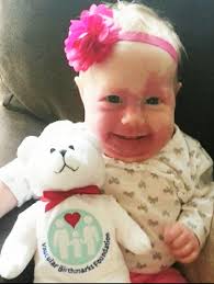 Vascular Birthmarks Foundation