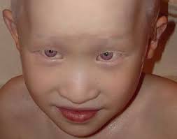 Violet Eyes Vitiligo Cure Vitiligo Treatment What Is Vitiligo