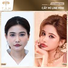 Lúc đầu cũng đắn đo nhiều, nhưng làm xong thấy quyết định này thật sự đúng.  Đôi mắt nhìn sáng hơn, có hồn hơn, gương mặt cũng tươi tắn hẳn ra." -