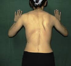Type I Scapular Dyskinesis Inferior Angle Is Winging With Isometric Contraction Isometric Contraction Ortho Scapular