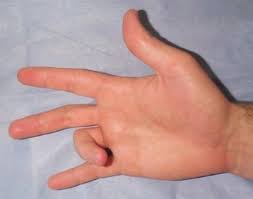 Check spelling or type a new query. Diabetes And Trigger Finger