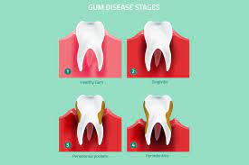Gum Disease / Gingivitis: How To Avoid It Or Treat It - From 123Dentist