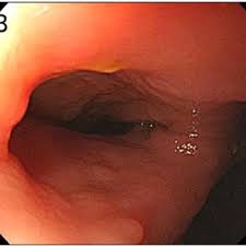 Image result for anal fistula