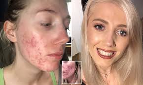 Acne Cure Woman Who Battled Severe Acne For Four Years Cures It In Three Weeks Daily Mail Online