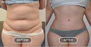 Mons Pubis Liposuction/Lift | Sydney Plastic Surgery