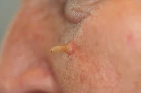 Image result for cornu cutaneum)