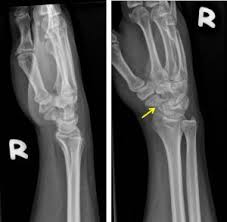 Image result for Scaphoid Fracture