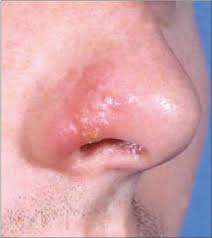 Diseased of nose and paranasal sinuse, bacterial infection of the nasal vestibule, nasal vestibulitis symbol. Infections Of The Nose And Paranasal Sinuses Ento Key