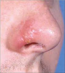 Infection of the skin of the nasal vestibule is termed nasal vestibulitis. Infections Of The Nose And Paranasal Sinuses Ento Key