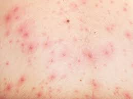 Image result for Varicella zoster on human skin