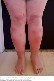 Image result for erythema nodosum