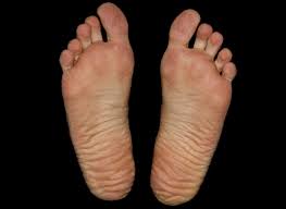 Untuk membut kulit halus dan tidak mengelupas tentunya anda harus menjaga telapak tangan. Penyebab Dan Cara Mengatasi Kulit Telapak Kaki Kering Dan Pecah Pecah Wadahtekno